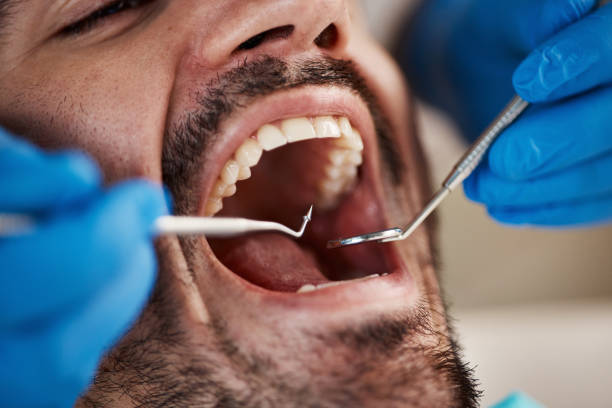 Best Emergency Tooth Extraction in Reston, VA